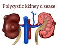 Polycystic kidney disease. genetic disease. Royalty Free Stock Photo